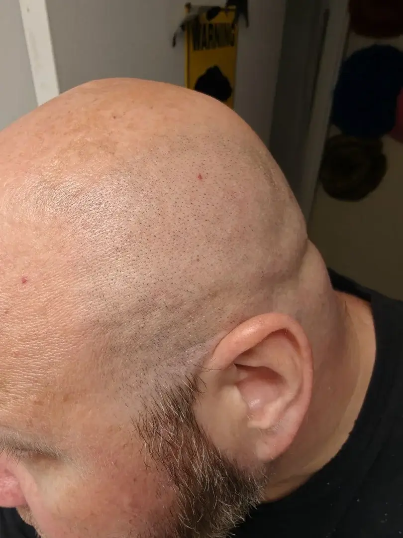 Philips Head Shaver Pro 9000 Series Review 2025: Is It Really the Smartest Bald Shaver Yet? | Smart Tech, Sharp Takes - CRYOVEX.com Clean shaved scalp after using the philips head shaver pro 9000 series showing smooth close finish.